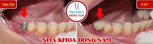 
(Cấy ghép răng Implant khi răng không còn giữ được nữa)
