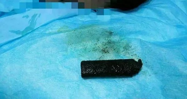 Chiếc bật lửa bị ăn m&ograve;n v&agrave; chuyển m&agrave;u đen. Ảnh: Knews.