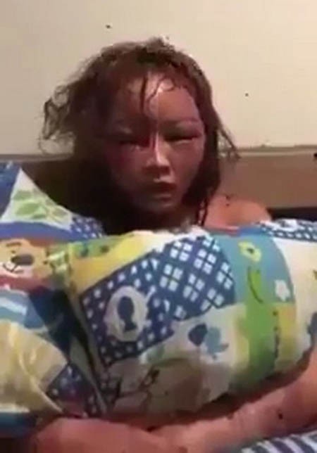 Khu&ocirc;n mặt biến dạng của Kuldara sau khi bị bạn trai bạo h&agrave;nh. Ảnh: Viral Press.
