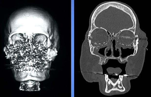 Gương mặt của Connie bị s&uacute;ng bắn vỡ vụn. H&igrave;nh ảnh trước v&agrave; sau khi phẫu thuật.