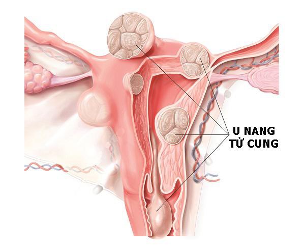 
U nang tử cung là một dạng bệnh lí về viêm cổ tử cung mãn tính, chiếm 3,3% các bệnh phụ khoa ở phụ nữ.
