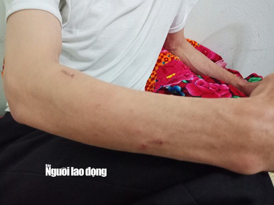 Những vết thương trên người anh Đinh Văn Điềm