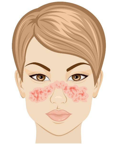 Vết phát ban hình con bướm cảnh báo nguy cơ mắc bệnh lupus. Ảnh: Pinterest.