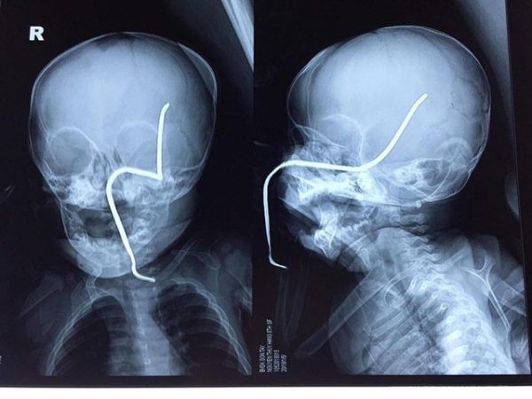 Hình ảnh phim X-quang của cháu H cho thấy thanh sắt đâm vào gò má trái, xuyên lên vùng não thái dương