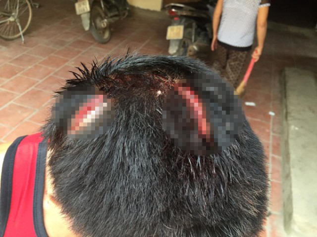 
Nạn nhân bị thương nặng ở vùng đầu.
