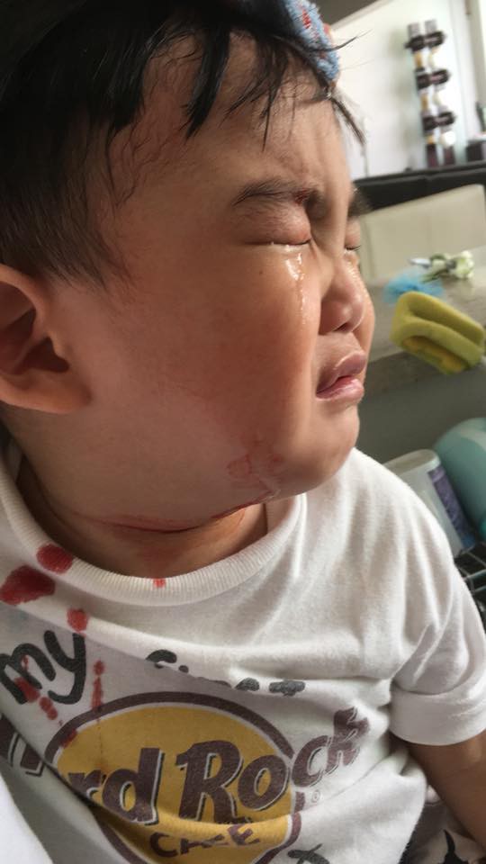 B&eacute; trai bị thương sau vụ việc.