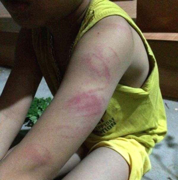 
Vết bầm tím trên cánh tay của học sinh T. bị nữ giáo viên chủ nhiệm cầm roi đánh. Ảnh: Bạn đọc cung cấp
