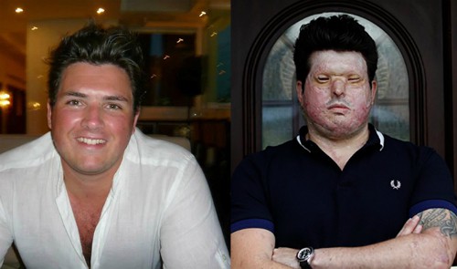 Andreas trước v&agrave; sau tai nạn - Ảnh: Reuters