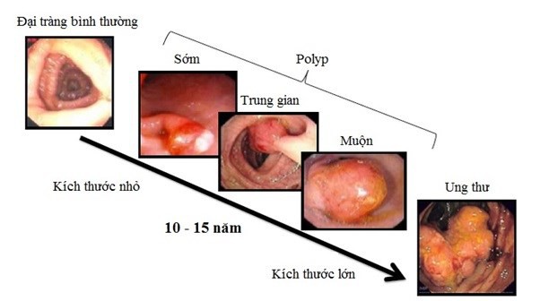 
Ung thư đại trực tràng đứng hàng thứ 5 trong các loại ung thư tiêu hóa hiện nay.
