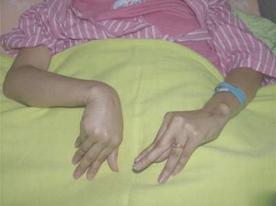 Bàn tay co rút - dấu hiệu hạ canxi máu.