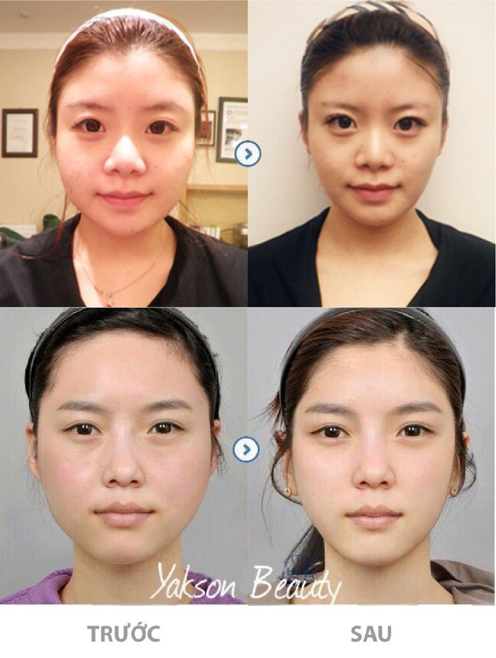 Hình ảnh trước sau của khách hàng đã tham gia liệu pháp Golki làm mặt V –Line tại Hệ thống Yakson Beauty.