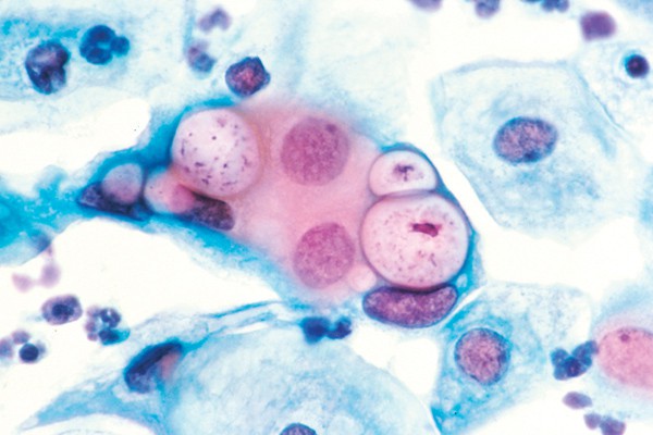 C. trachomatis gây nhiễm khuẩn đường sinh dục