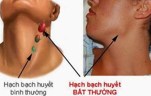 
Đây là một loại bệnh ung thư của các hạch bạch huyết
