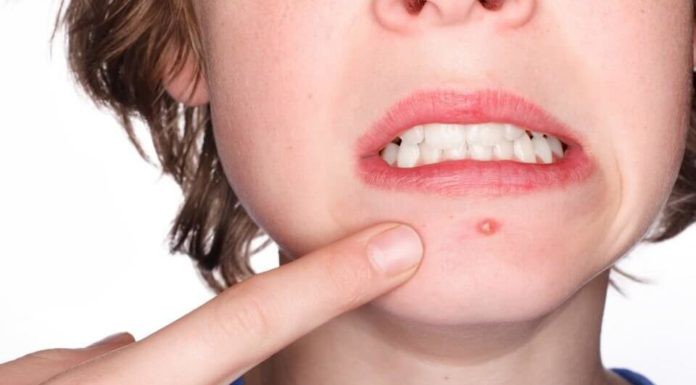 Thoa nước đu đủ xanh để những chiếc mụn nhọt không tàn phá da bạn nữa. Hình minh họa