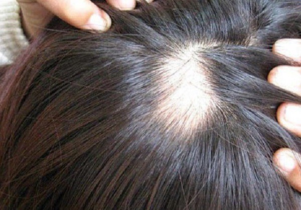 
Rụng trên 100 sợi tóc mỗi ngày là bệnh lý, bạn cần đi khám để điều trị tránh bị hói đầu.     Ảnh: T.G
