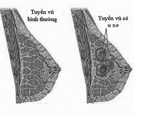 U xơ tuyến vú là một bệnh lành tính.