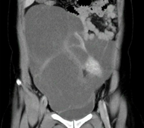 Hình CT scan cho thấy khối u chiếm gần toàn bộ ổ bụng, từ vùng chậu lên đến sát gan.