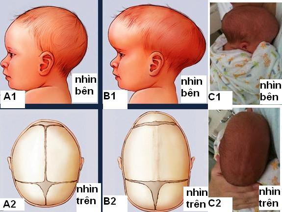 
Dính khớp sọ ở trẻ
