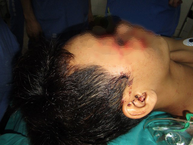 
 Hình ảnh bệnh nhân bị dị vật găm vào mặt khi vào viện.
