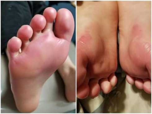 Đôi bàn chân bị bỏng độ 2 của cậu bé.