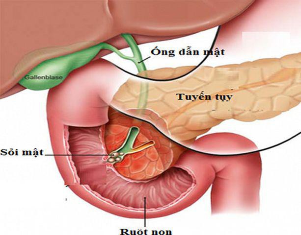 
Viêm tuyến tụy cấp tính nguyên nhân một phần do ăn uống quá độ
