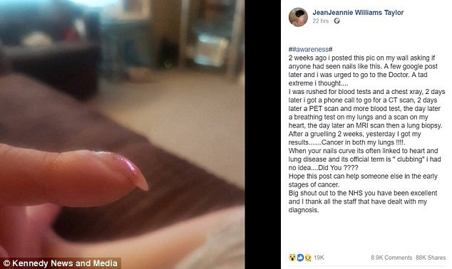 
Bà chia sẻ câu chuyện phát hiện ung thư nhờ móng tay của mình lên Facebook.
