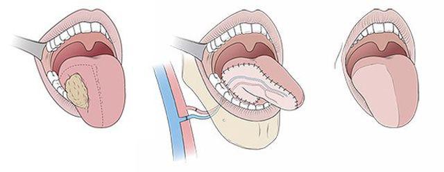 
Cô Vương bắt buộc phải cắt một nửa lưỡi (Ảnh minh họa)
