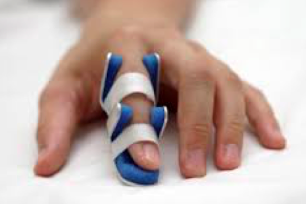 
Bác sĩ có thể cho bệnh nhân mang nẹp giữ các ngón tay ở vị trí trung tính nếu tình trạng ngón tay lò xo ở dạng nhẹ.
