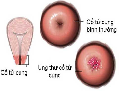 
Ung thư cổ tử cung là bệnh ung thư thứ hai sau ung thư vú ở phụ nữ
