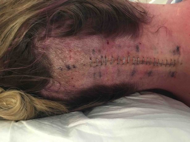 
Cô đã được phẫu thuật cắt bỏ khối u 2,2cm nhưng rồi điều tồi tệ nhất vẫn xảy ra.
