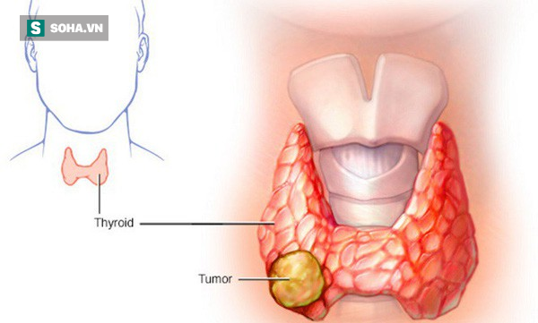 
Ung thư tuyến giáp thường xuất hiện khối cục ở cổ như bướu
