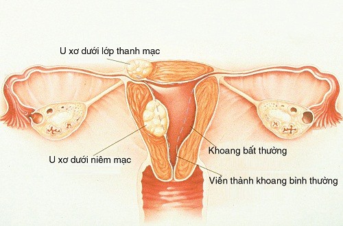 
Người bệnh có bất thường vế cấu trúc tử cung do u sơ
