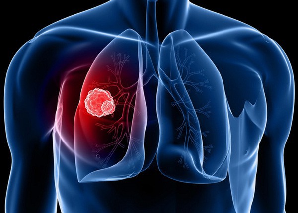 
Thực tế, ung thư phổi có thể xuất hiện ở người không hút thuốc.
