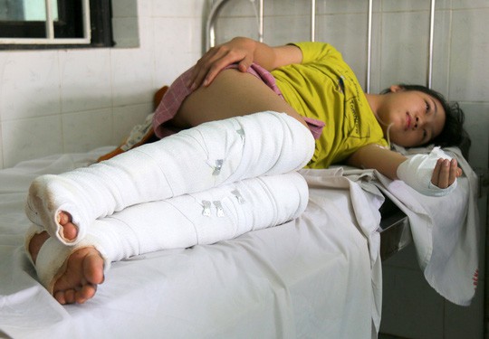 
Em Trần Mỹ Duyên cũng bị phỏng nặng trong lúc cứu mẹ
