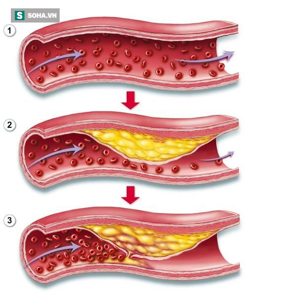 
Mạch máu thường bị tắc theo thời gian do mỡ máu (Ảnh minh họa)
