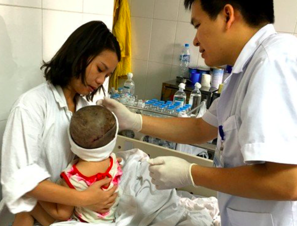 
Bé Quỳnh Trâm thời điểm bị tai nạn (2016), được các bác sĩ BV Việt Đức cứu chữa.
