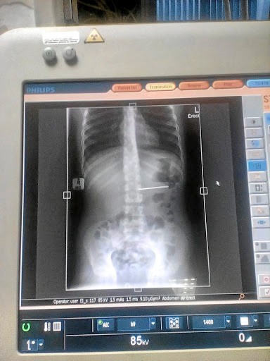 Hình ảnh chụp X-quang cho thấy chiếc kim nằm trong dạ dày nạn nhân. Ảnh: Timeslive.