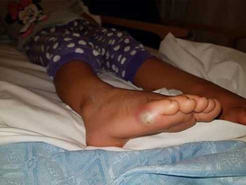 
Bé gái không đi tất thử giày và đã bị nhiễm khuẩn dẫn tới nhiễm trùng máu.
