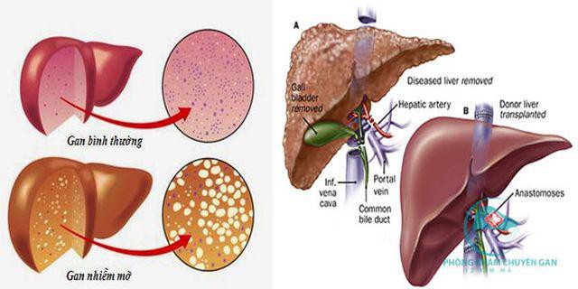 
Hình ảnh minh họa gan bị nhiễm mỡ
