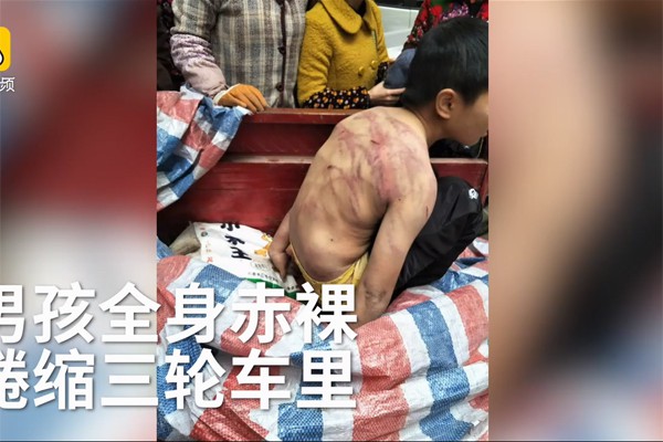 
H&igrave;nh ảnh cậu b&eacute; bị đ&aacute;nh th&acirc;m t&iacute;m cả lưng.
