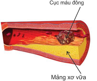 
Cục máu đông gây chít hẹp lòng mạch, tắc mạch
