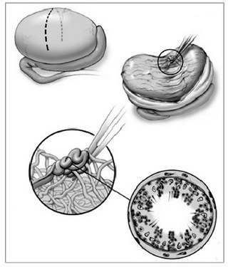 
Vi phẫu tích mô tinh hoàn (microTESE) tìm những nơi có ống sinh tinh giãn to, trong đó thường có tinh trùng.

