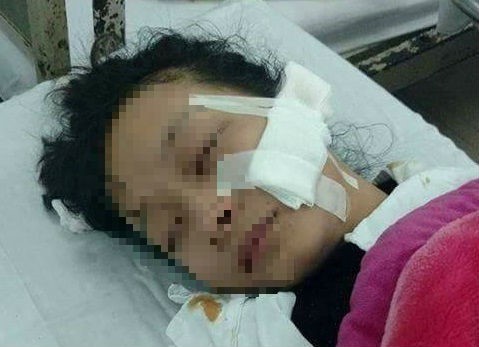 Nữ sinh Lan Anh bị đâm rách vùng mặt, kéo dài từ toàn bộ phần má đến mang tai. Ảnh: M.C.