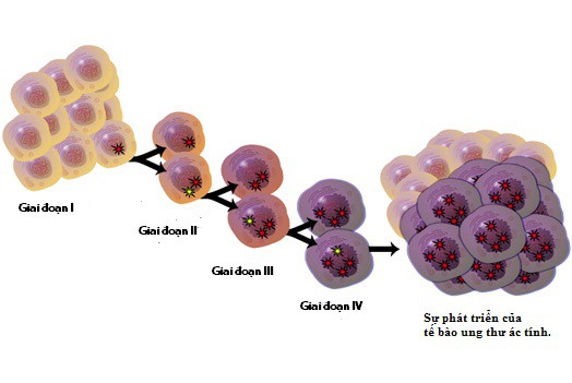 
Các giai đoạn biến đổi của tế bào ung thư.
