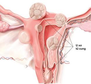 Bệnh phụ khoa có thể gây ra nhiều nguy hiểm cho sức khỏe nữ giới