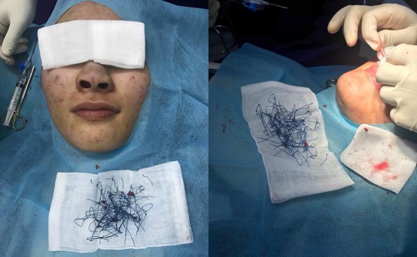 Hàng trăm sợi chỉ được gắp ra từ mũi bệnh nhân