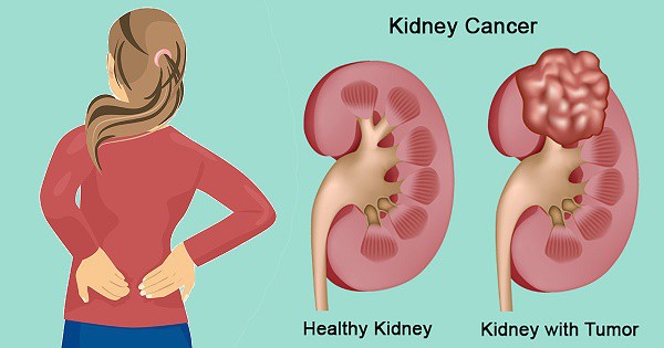 
Một trong những yếu tố dẫn đến ung thư thận có thể là do sỏi thận.
