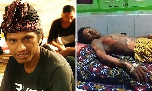 Dedi Purnama trước v&agrave; sau khi bị vợ ch&acirc;m lửa thi&ecirc;u sống.