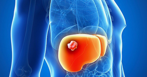 
Đau bụng là triệu chứng điển hình ở bệnh nhân ung thư gan

