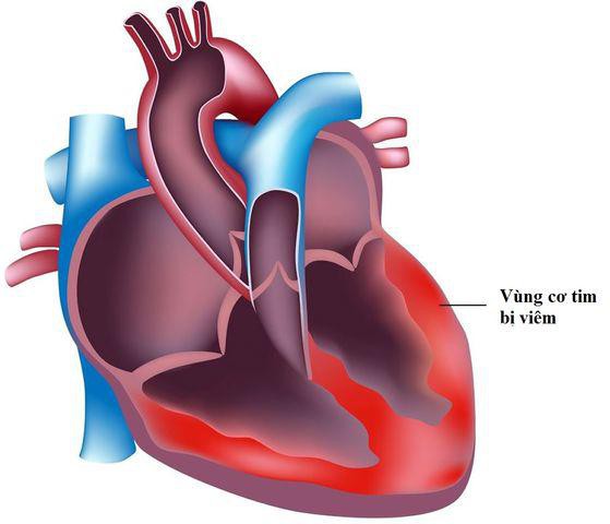 
Bé gái bị viêm cơ tim do virus.
